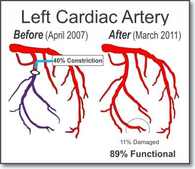 Left Cardiac Artery