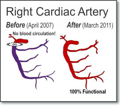 Right Cardiac Artery
